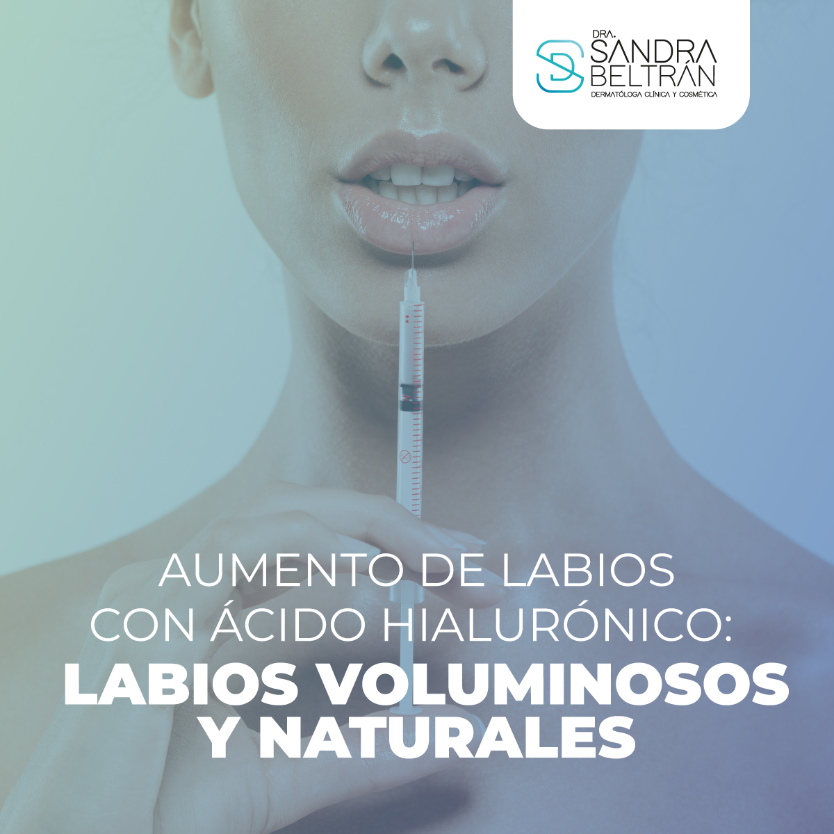Aumento de Labios con Ácido Hialurónico: Labios Voluminosos y Naturales
