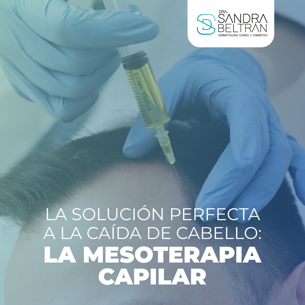 La solución perfecta a la caída de cabello: la mesoterapia capilar