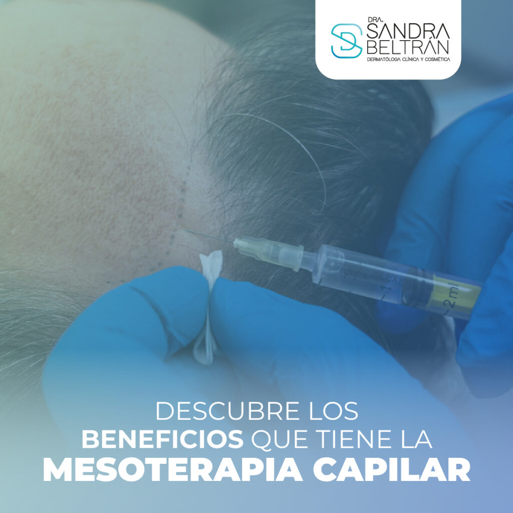 Descubre los beneficios que tiene la mesoterapia capilar