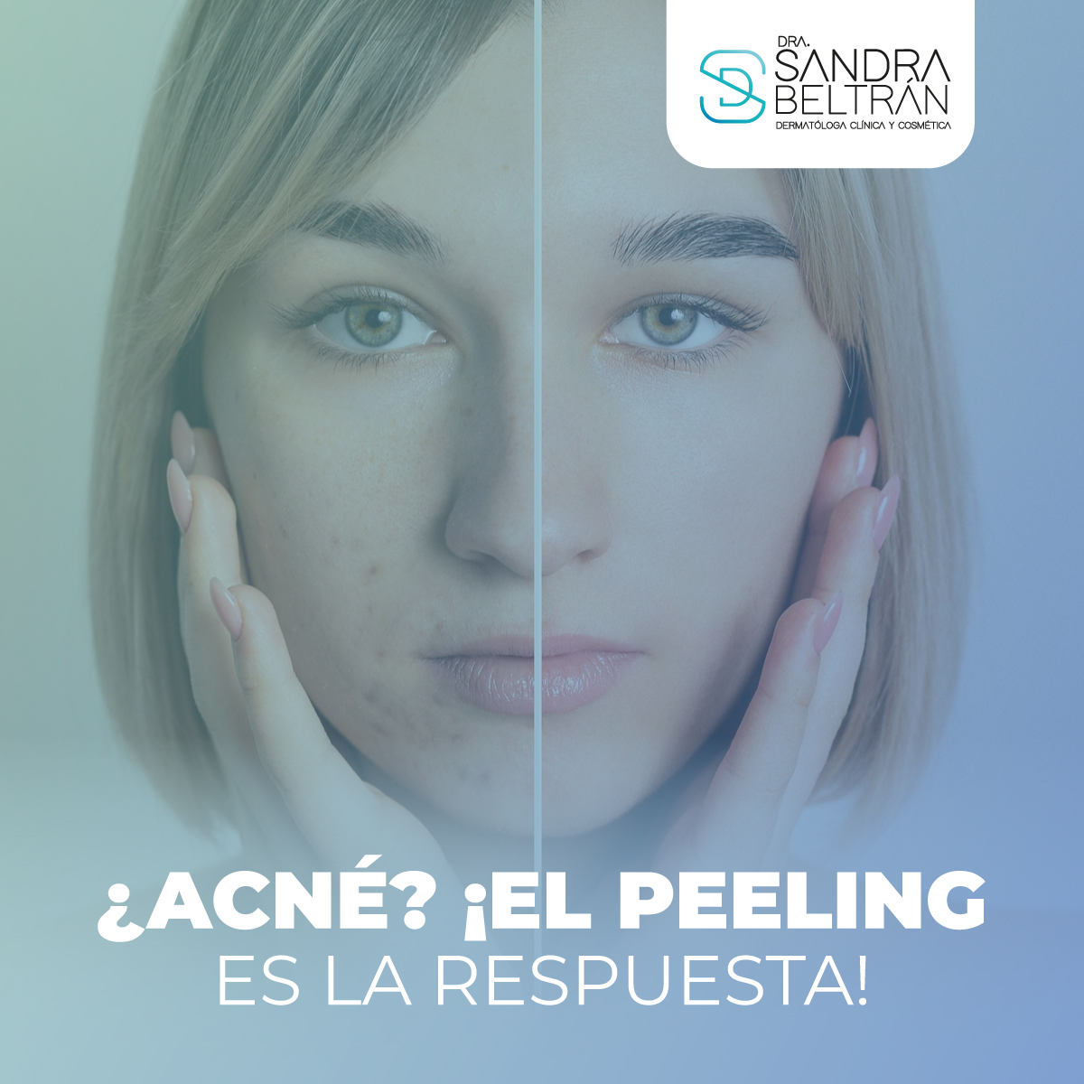 ¿Acné? ¡El peeling es la respuesta!