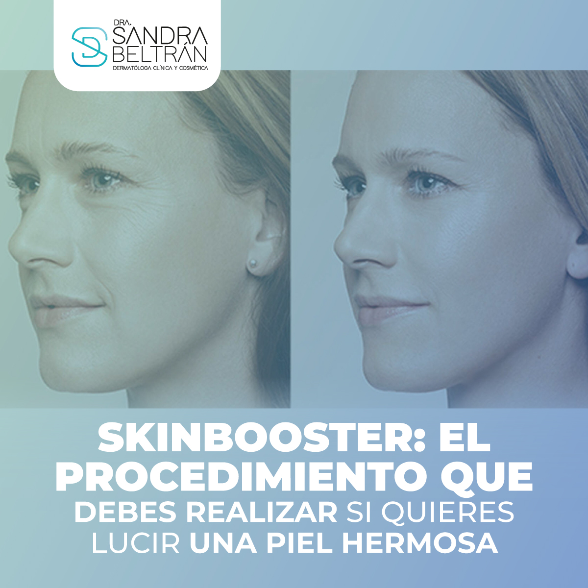 Skinbooster: el procedimiento que debes realizar si quieres lucir una piel hermosa