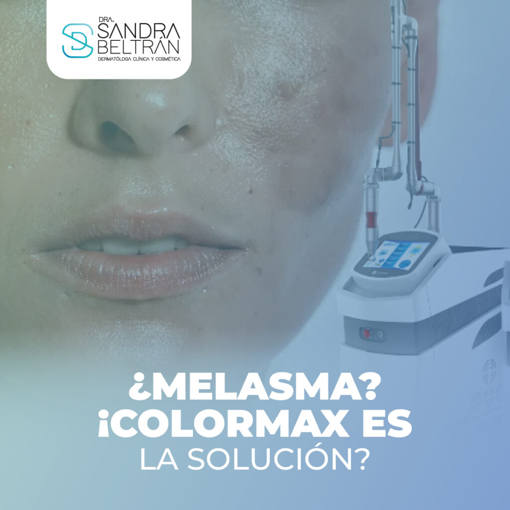 ¿Melasma? ¡Colormax es la solución!