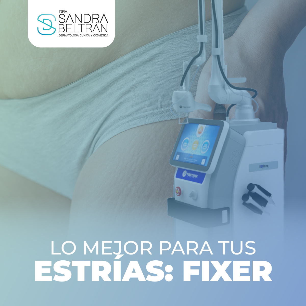 Lo mejor para tus estrías: FIXER